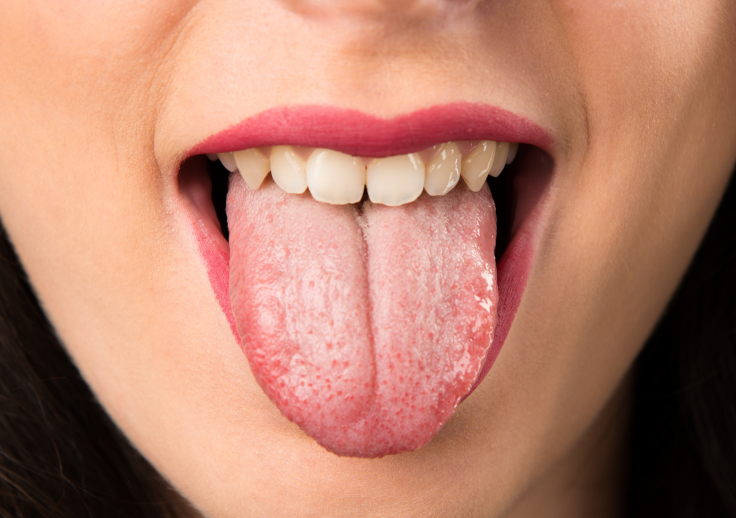 舌が白い・ヒリヒリするのは大丈夫？放置NGのサインと考えられる病気を解説